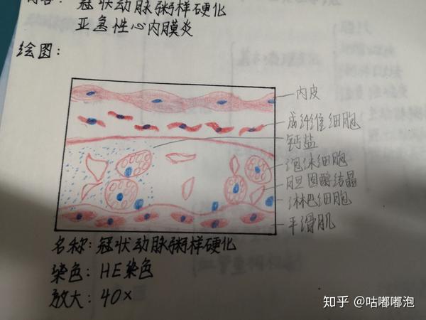 20.亚急性心内膜炎