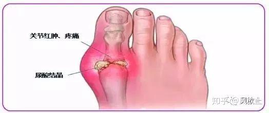 深夜脚大拇指疼痛是痛风来了做到3不4好痛风躲着你