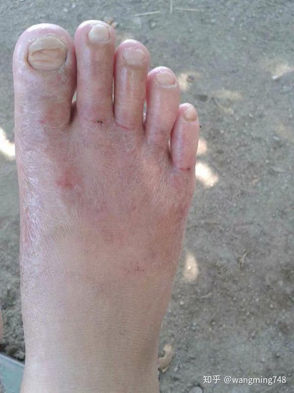 脚气简介        脚气(俗名"香港脚",脚癣),系真菌感染引起,其皮肤
