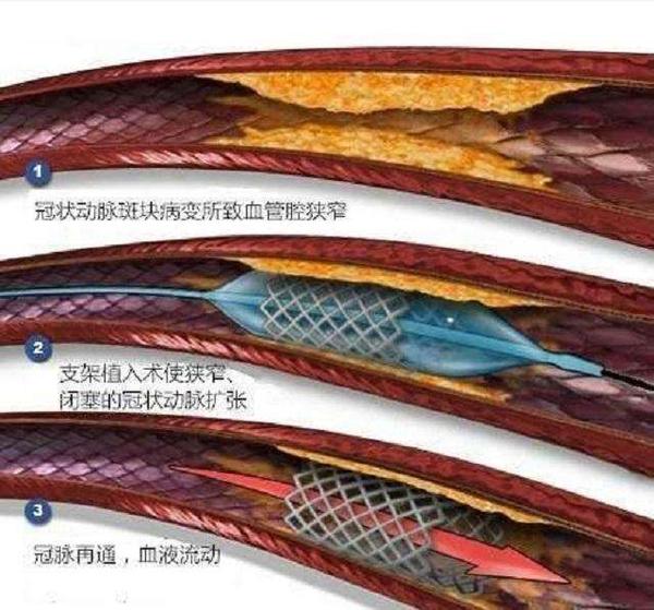 万事大吉;心脏支架只是急救急性心肌梗死以及缓解药物无法控制的心