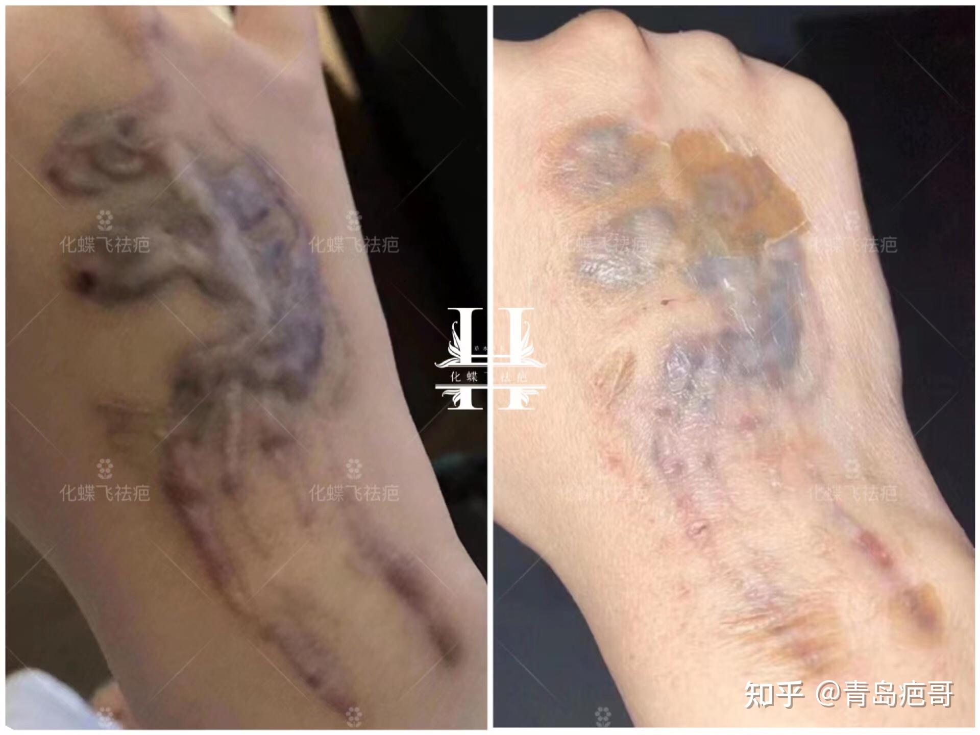 洗纹身增生疤痕怎么修复