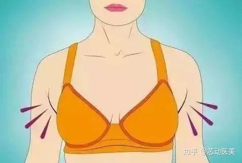 副乳别轻视可能是乳腺癌淋巴癌的前奏