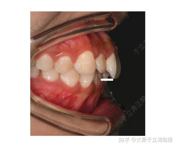 太原牙齿矫正不整齐的牙齿是如何矫正顺带改善面型的