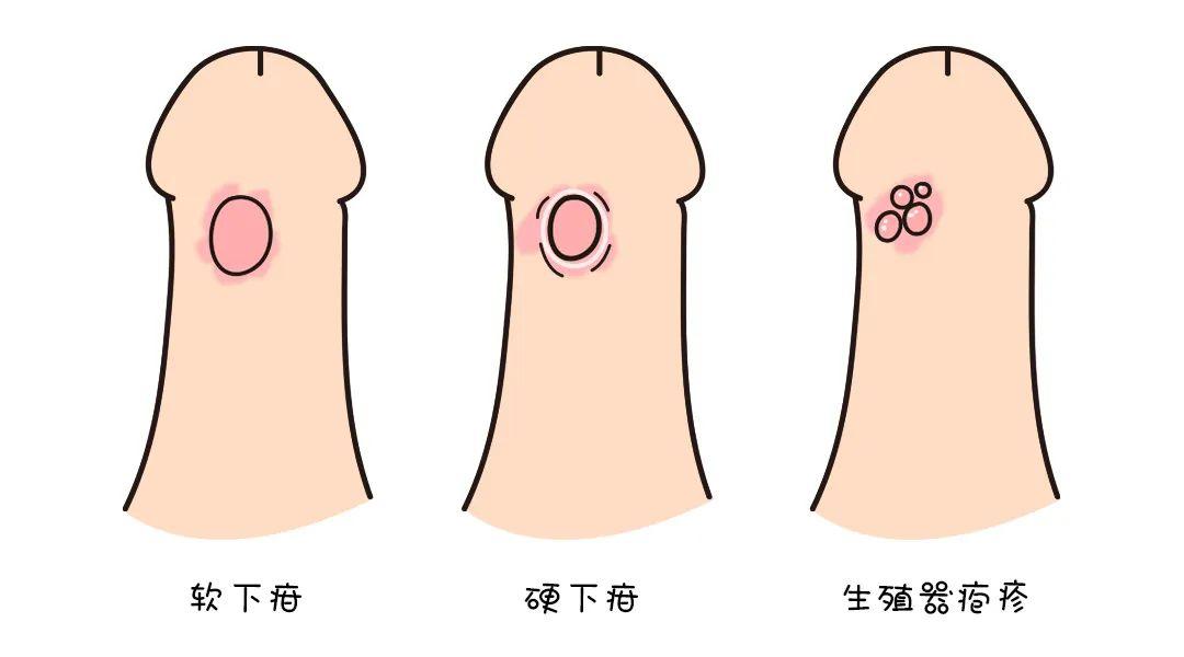 大咖说性丨"亲 一下又不会怎么样 怕是有梅毒?