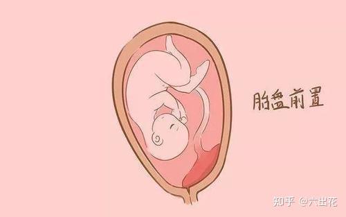 孕期胎盘低置一般是什么原因引起的