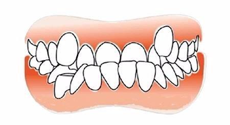 仙游牙齿矫正科普畸形牙齿矫正是怎样的过程