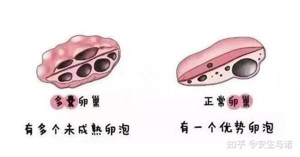 多囊卵巢综合症可以做试管婴儿吗?