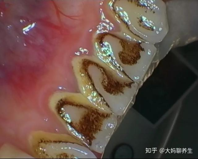 茶渍和烟渍以及日积月累的牙结石,牙菌斑,但对于牙齿长期,深部的色素