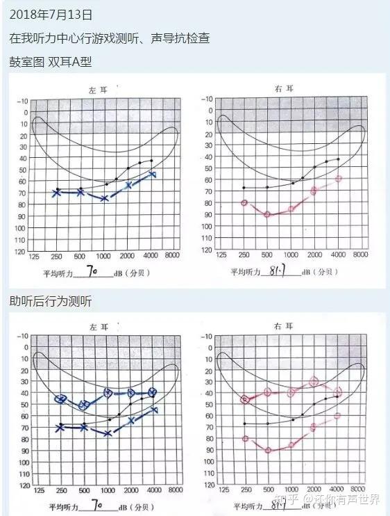 2015年5月15日dpoae测试,双耳未通过下面是该患者相关的听力学报告:雷