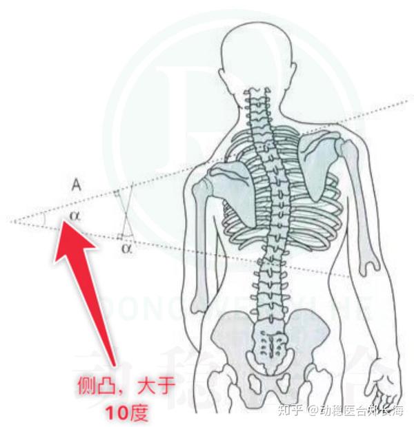 什么是脊柱侧弯?