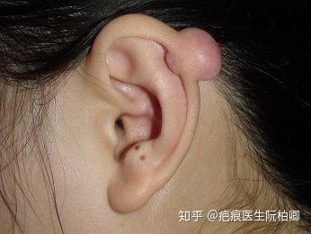 耳垂疤痕疙瘩有哪些特征?