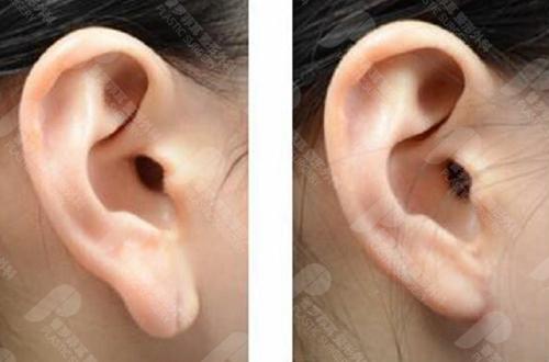 耳垂太大可以缩小吗?手术有没有什么风险?