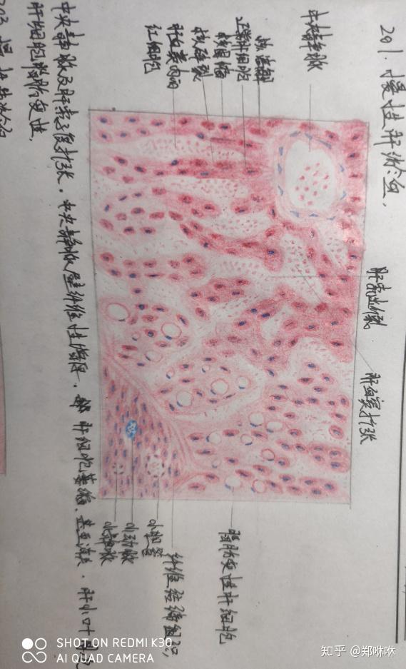 肝索是由两排肝细胞堆积而成的,我画的只有一排 肝细胞水肿 这个图