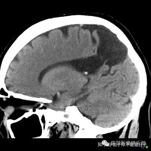 灰质异位