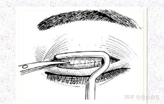 在睑板上缘上方近外眦部纵行剪开腱膜.