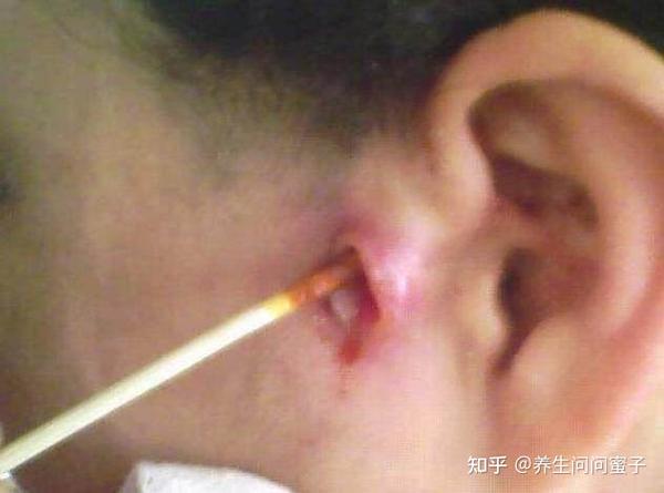 6岁男孩耳朵潮湿发痒,医院一查长了真菌,可能流脓失聪