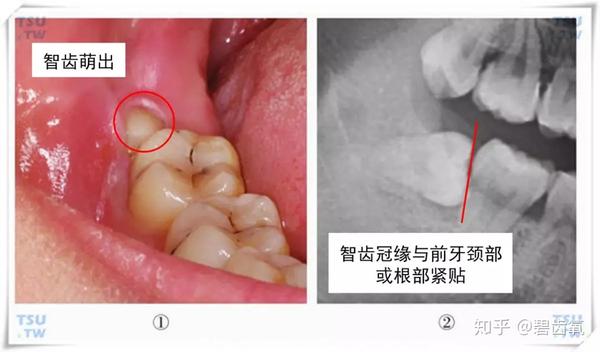 ▼非正位智齿损害威胁期智齿已确定不能正常萌出且构成对周围组织损害