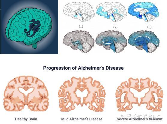 海马体和阿尔茨海默症发病进程2,3,4