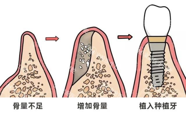 当吃饭吃不好的时候才注意到牙齿缺失的危害,此时想种植牙齿,可是牙