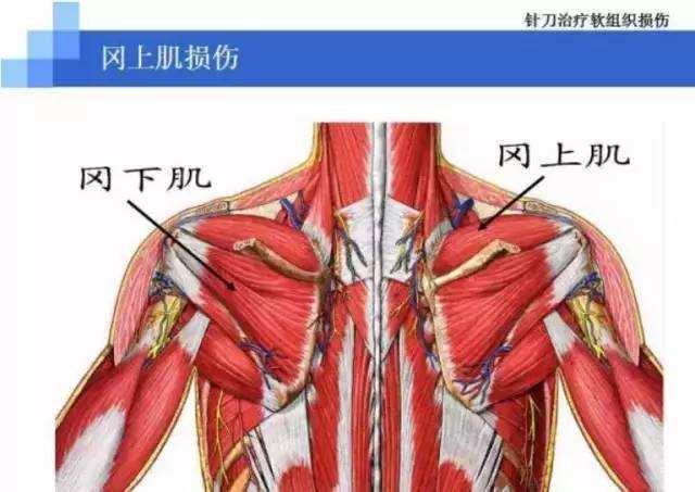 手臂外侧疼痛区域而忽略掉了触发区域,所以处理冈上肌应该效果更明显