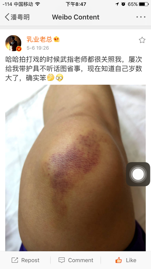 昨天潘老师微博发了膝盖上伤的照片