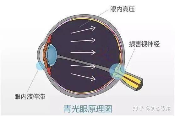 你的眼压是否正常?