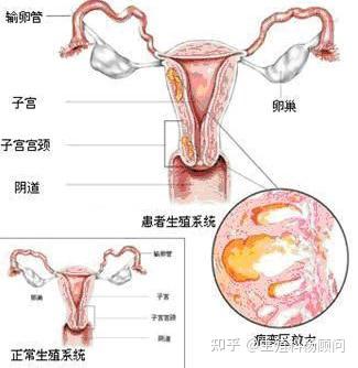 子宫腺肌病是子宫内膜腺体和间质侵入子宫肌层形成弥漫或局限性的