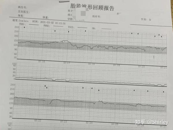 一,怎么看胎心监测报告图?