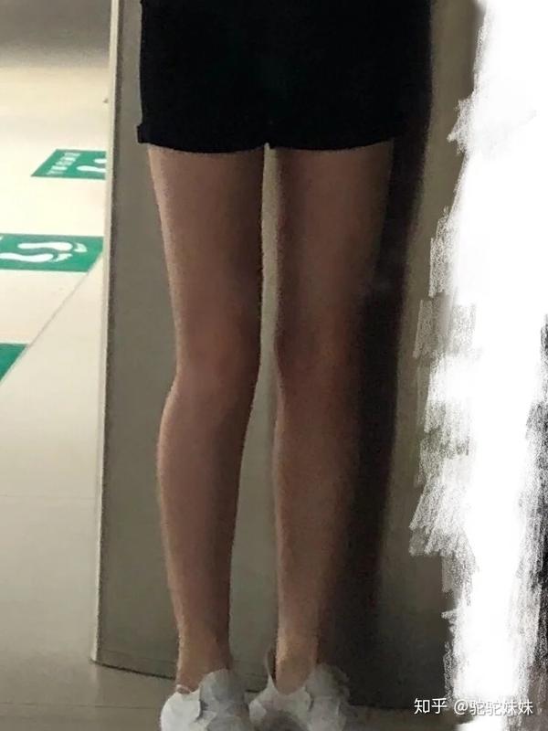 我做了大腿环吸才发现,我的腿原来是直的!