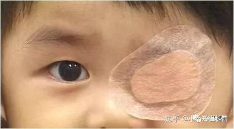视轴矫形运动有很多种类,外斜视患者可以做眼球肌肉汇聚运动,而内