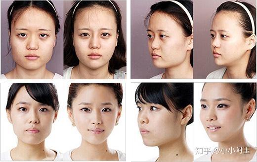 想磨骨,但是担心术后后遗症和效果?