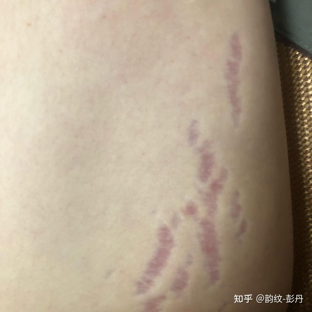 因为肥胖而产生的肥胖纹可以去掉吗怎么去掉