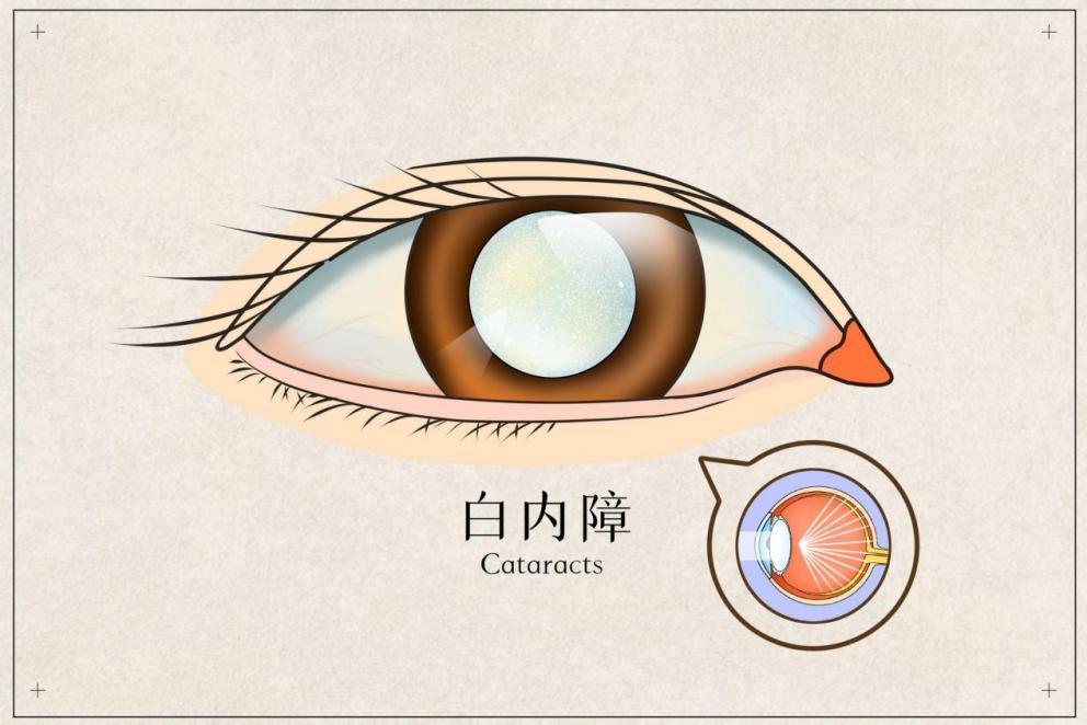 体检查出白内障有相关经验分享下需要注意什么吗