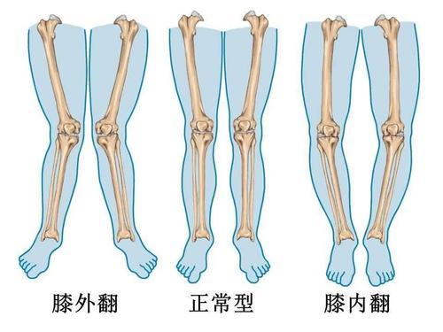 青少年与你不可忽视的xo型腿