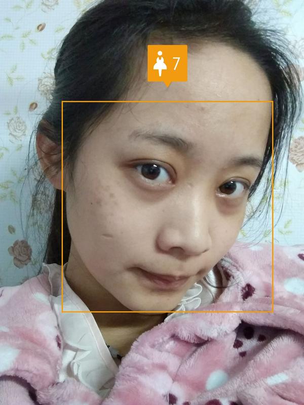 双眼皮 全切6mm&开眼角
