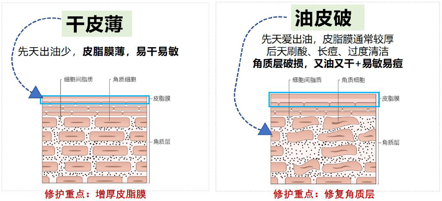 油皮则较为复杂:皮脂腺分泌油脂过多,毛囊口容易堵塞,引发局部炎症