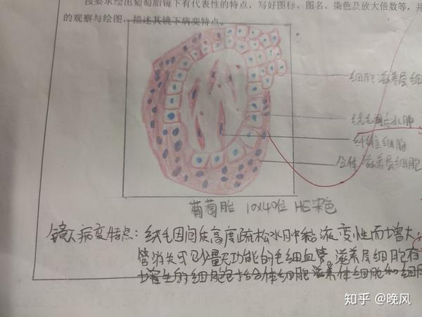 11.甲状腺乳头状腺癌