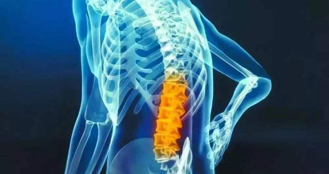 腰椎管狭窄症可导致马尾神经受压迫,出现马鞍区的症状,与体征以及