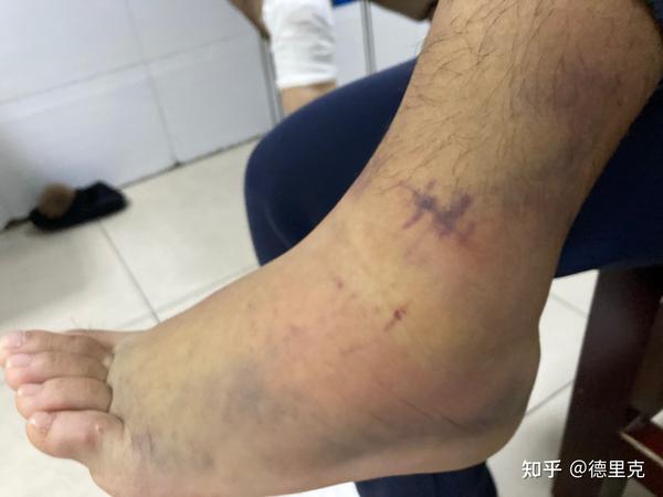 脚踝扭伤撕脱性骨折4周下地走路简单分享下康复过程以及错误治疗