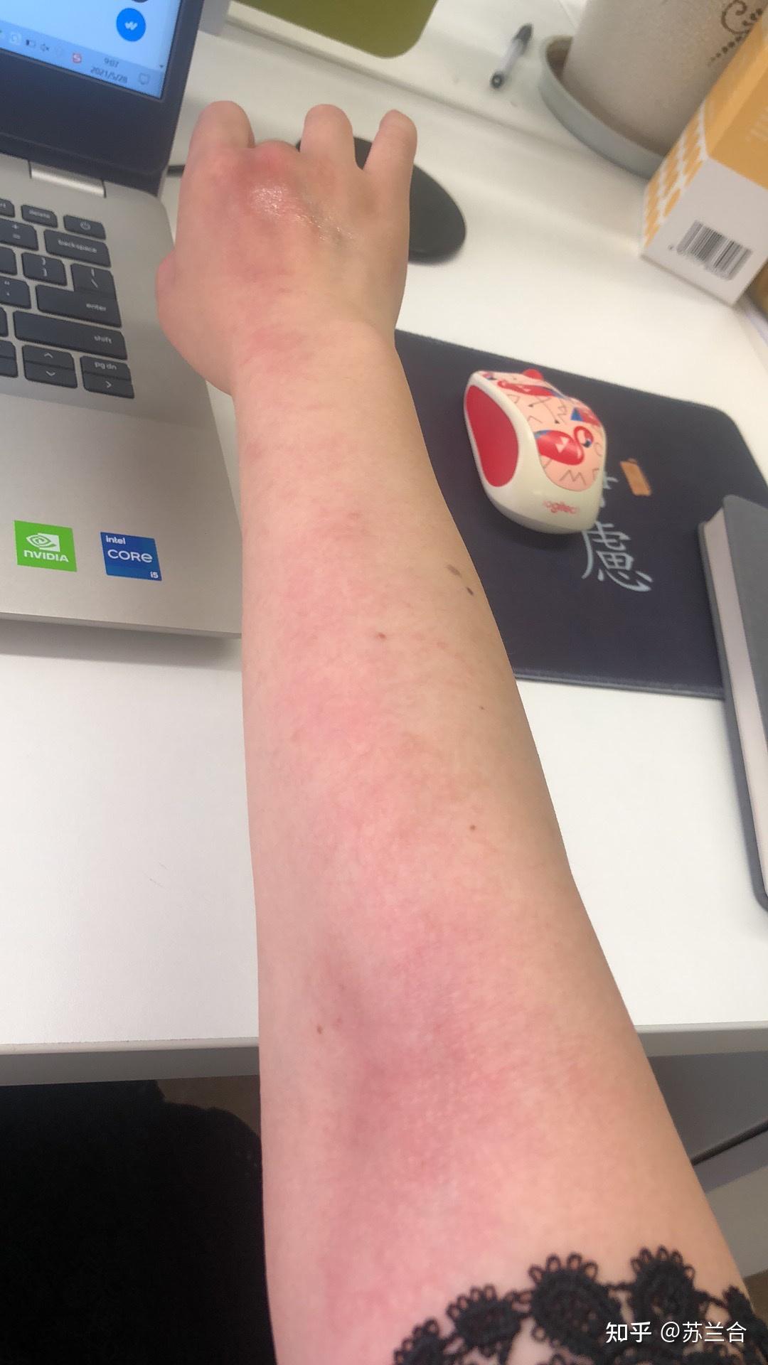 为何被蚊子叮过之后会整条手臂类似于顺着血管都红了