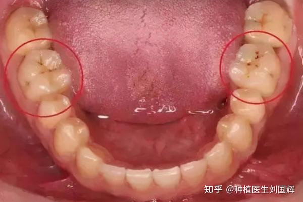 如果牙齿上出现小黑点,事情没那么简单!可能要面临拔牙.