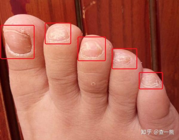 根据症状图片来看像是真菌感染引起的灰指甲,症状表现为甲凹凸,且伴随
