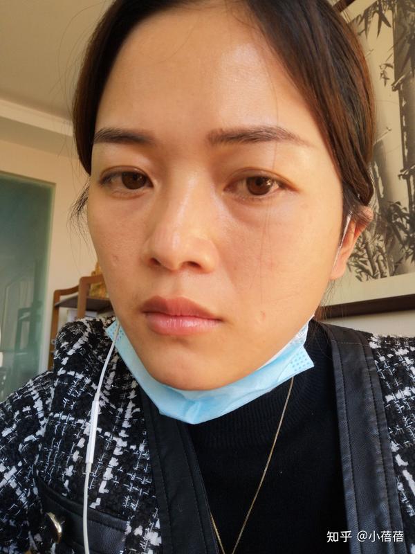 上眼睑松弛去皮去脂外切去眼袋框格释放去皮去脂双眼皮眼袋手术