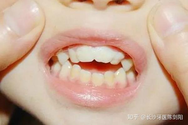 下牙包住上牙,可以造成月牙脸,影响颜面美观.