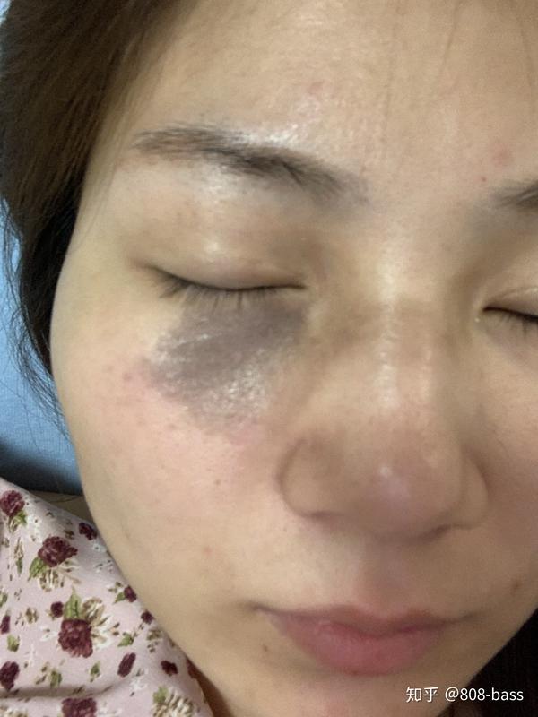 太田痣半个月后 反黑了