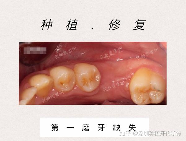 牙痛没及时找医生治疗,后面的大牙都蛀了,烂到了牙根