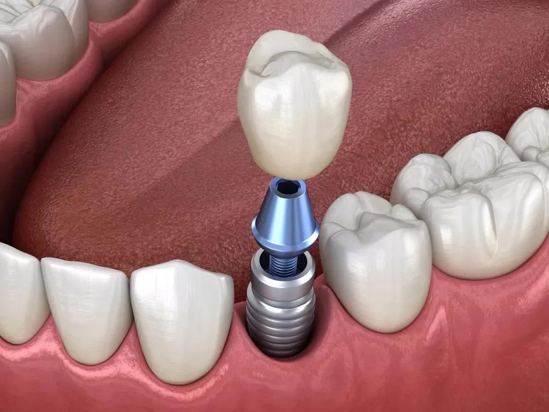 有种植牙存在时,一般都设计种植牙不动,其他牙齿来移动从而完成矫正.