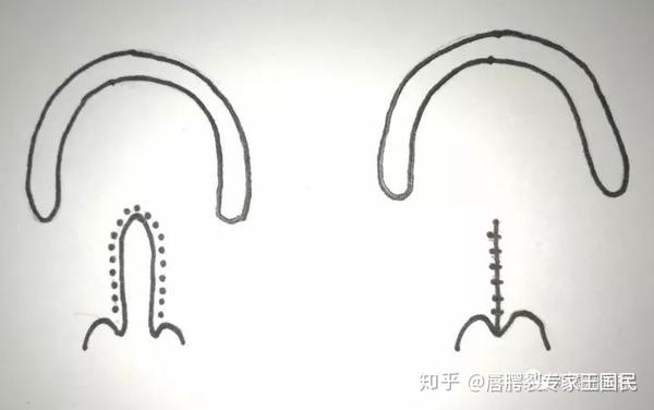 【腭修复的松弛切口】