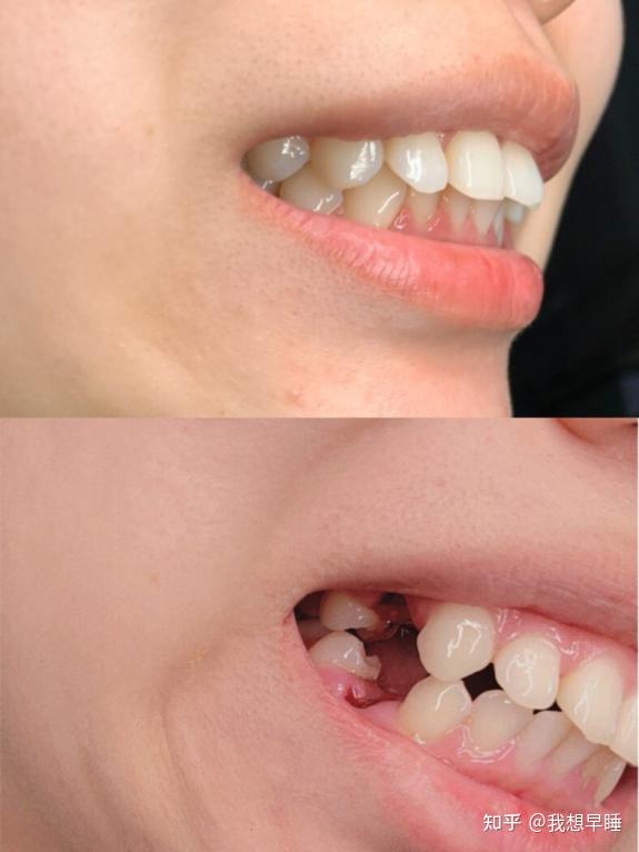 北京牙齿矫正拔了8颗牙一年内收7mm
