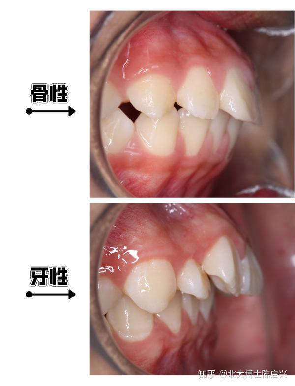 怎么判断自己是骨性龅牙还是牙性龅牙?
